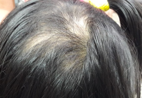 Alopecia Areata: After