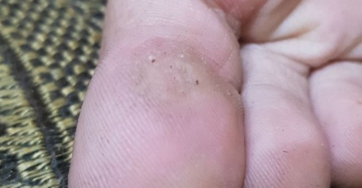 Viral Warts: After