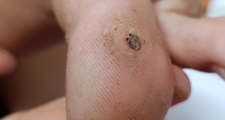 Viral Warts: Before